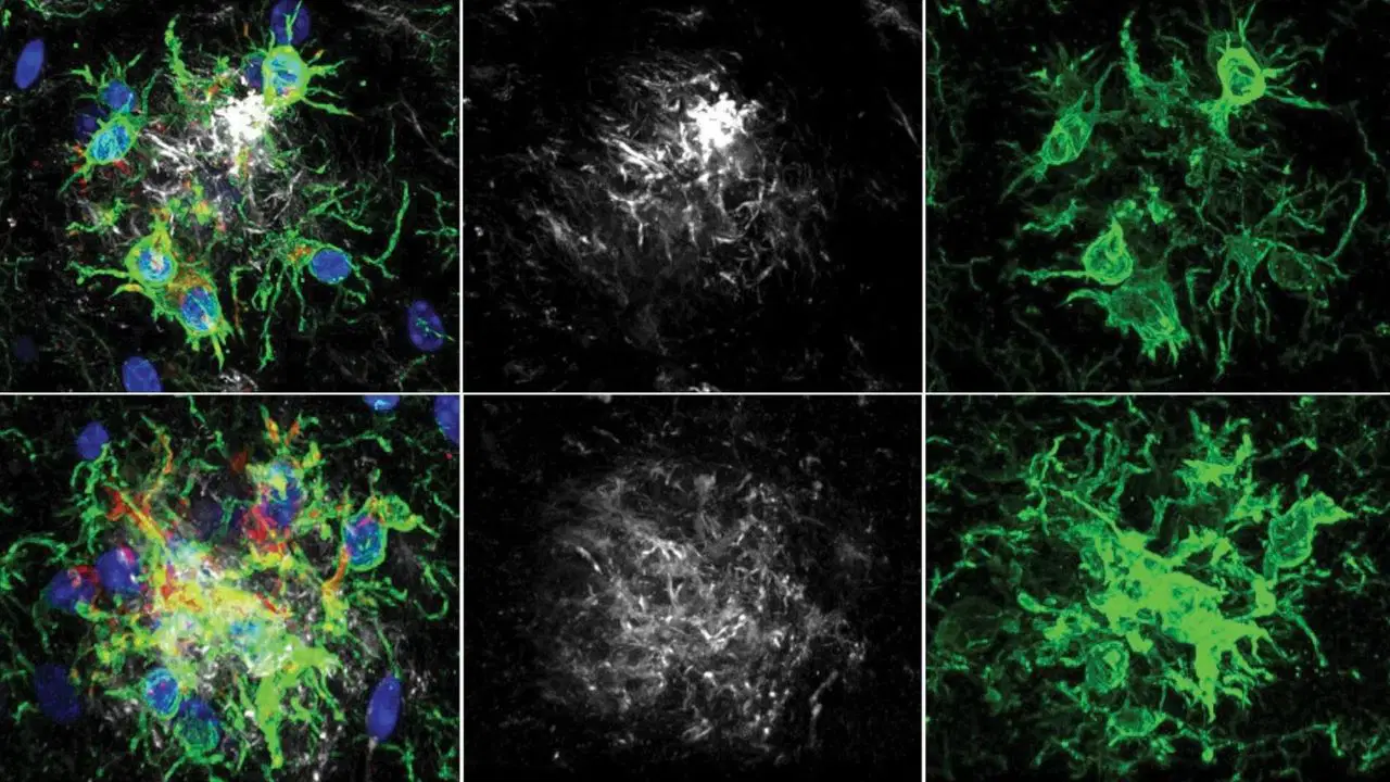 Alzheimer Tedavisinde Çığır Açan Gelişme: Beynin Temizlik Mekanizması Yeniden Güçlendirildi