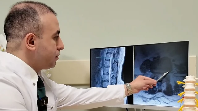 Bel Fıtığı ile İlgili Önemli Bilgiler: Ameliyat Son Çare Olmalı